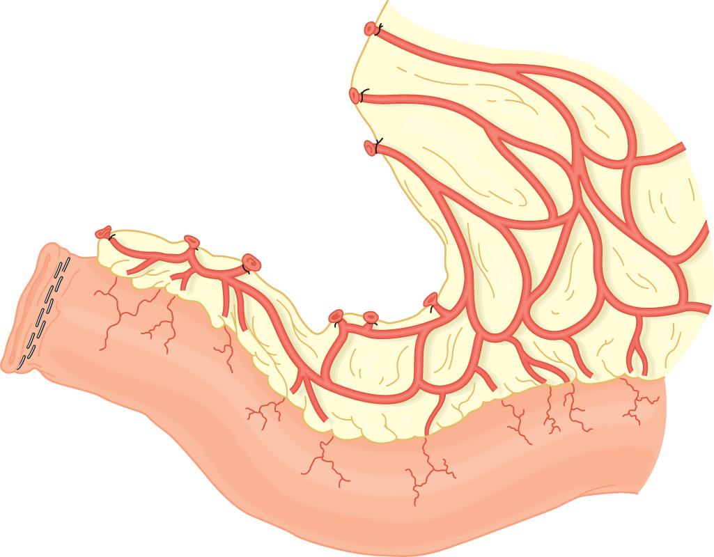 FIGURE 178.5, The ileum is prepared for ileostomy creation.