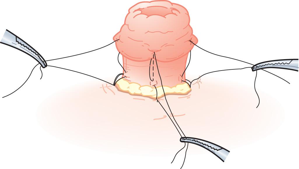 FIGURE 178.6, Tripartite bites between the dermis, the seromuscular layer of the bowel wall at the fascial level, and full thickness of the cut edge evert the stoma.