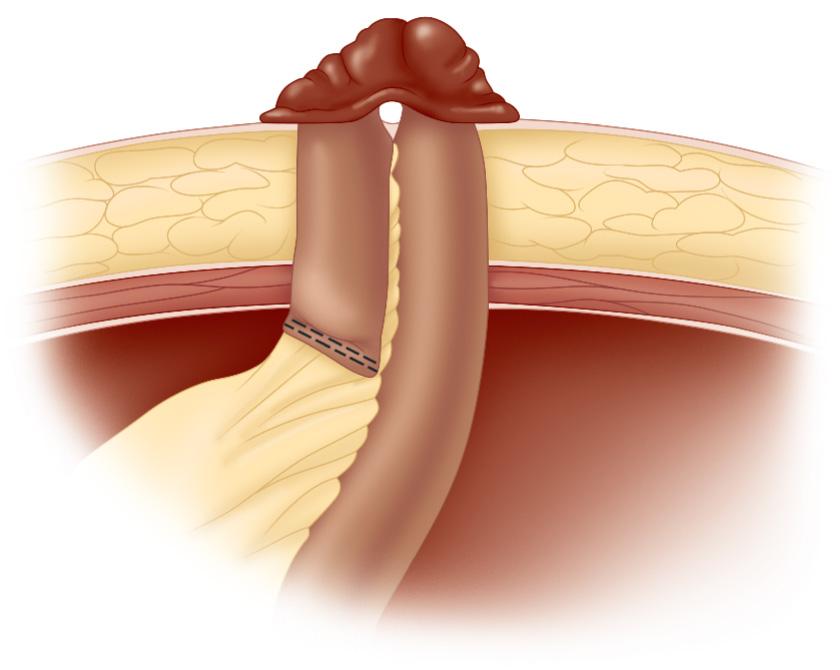 FIGURE 178.7, Creation of a loop end stoma.