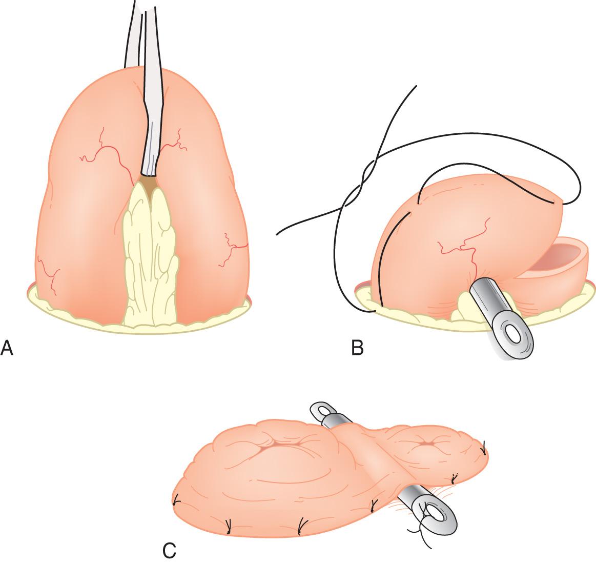 FIGURE 178.8, Creation of a loop ileostomy with support rod. (A) A 4- to 5-cm loop of distal ileum is brought through abdominal aperture with no twist. (B) A stoma rod is passed through the mesentery. The ileum is opened toward the nonfunctioning limb and a tripartite suture is placed. (C) The rod is sutured to the skin and the remainder of the ileostomy is matured with sutures.