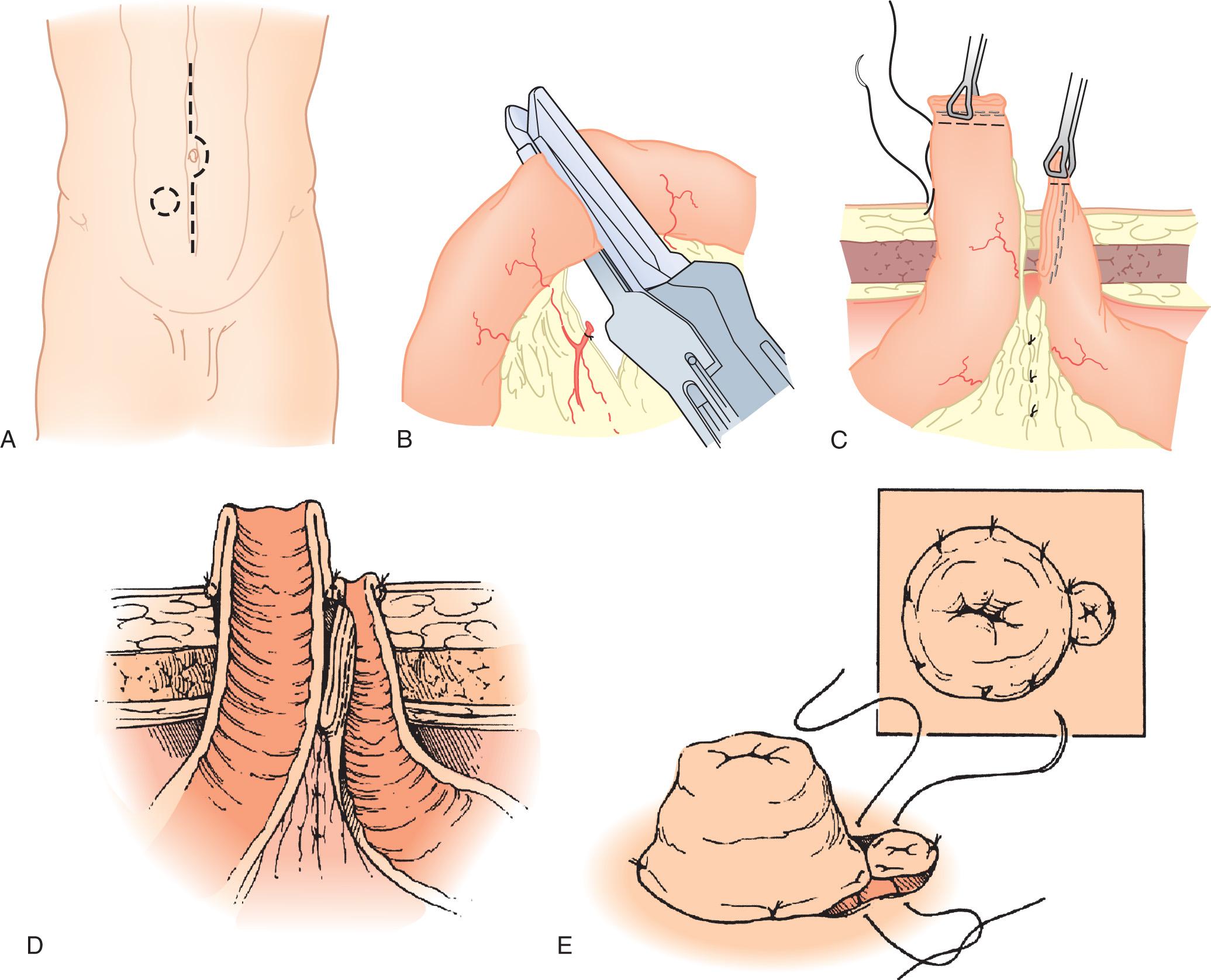 FIGURE 178.9, Creation of an end loop ileostomy. (A) The abdomen is explored through a midline incision and the ostomy opening is created as previously described (see Figs. 178.2 to 178.4 ). (B) A segment of ileum that will reach the abdominal wall is selected and divided with a liner cutting stapler. (C) Divided ends of the ileum are brought through the ostomy aperture (functional end is marked with a suture). (D) The staples of the functional end are excised and the bowel is matured producing a 2 cm spout. Staples at the antimesenteric end of the nonfunctioning end are excised, and the small end is sutured to the deep dermis and medial edge of functioning stoma. (Sagittal view.) (E) Completed ileostomy.