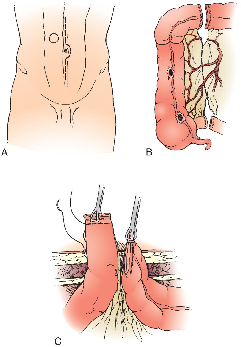 FIGURE 178.10, Creation of an end loop ileocolostomy. (A) Abdomen is explored via midline incision. (B) Terminal ileum and right colon are resected. (C) Functional end of ileum and end of nonfunctional colon are brought through the ostomy aperture. Ostomy is matured as in Fig. 178.9D and E .