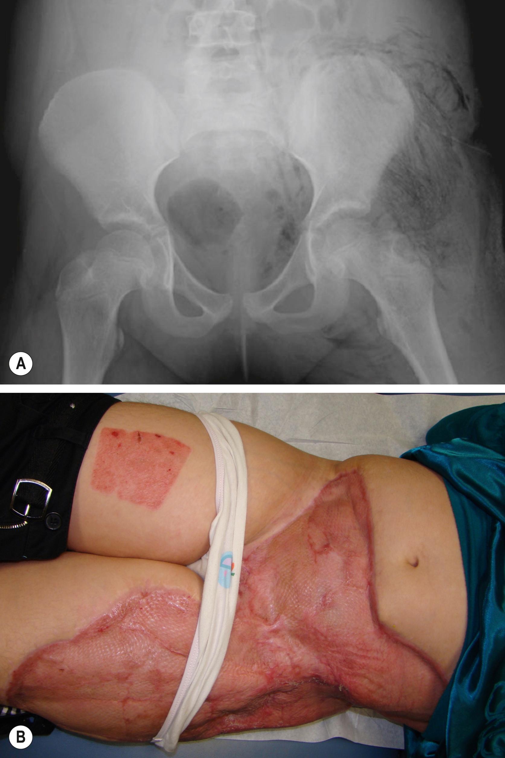 FIGURE 191.1, 9-year-old girl with MyD88 deficiency (caused by myeloid differentiation primary response gene) had a 5-day history of abdominal pain and acute onset of left thigh and buttock pain. (A) Frontal radiograph shows diffuse, left-sided linear radiolucencies indicative of gas in muscle planes and soft tissues. (B) Urgent, widely extensive, and frequent operative debridement procedures were performed, followed by muscle flap and grafting. Clostridium septicum was isolated from tissue.