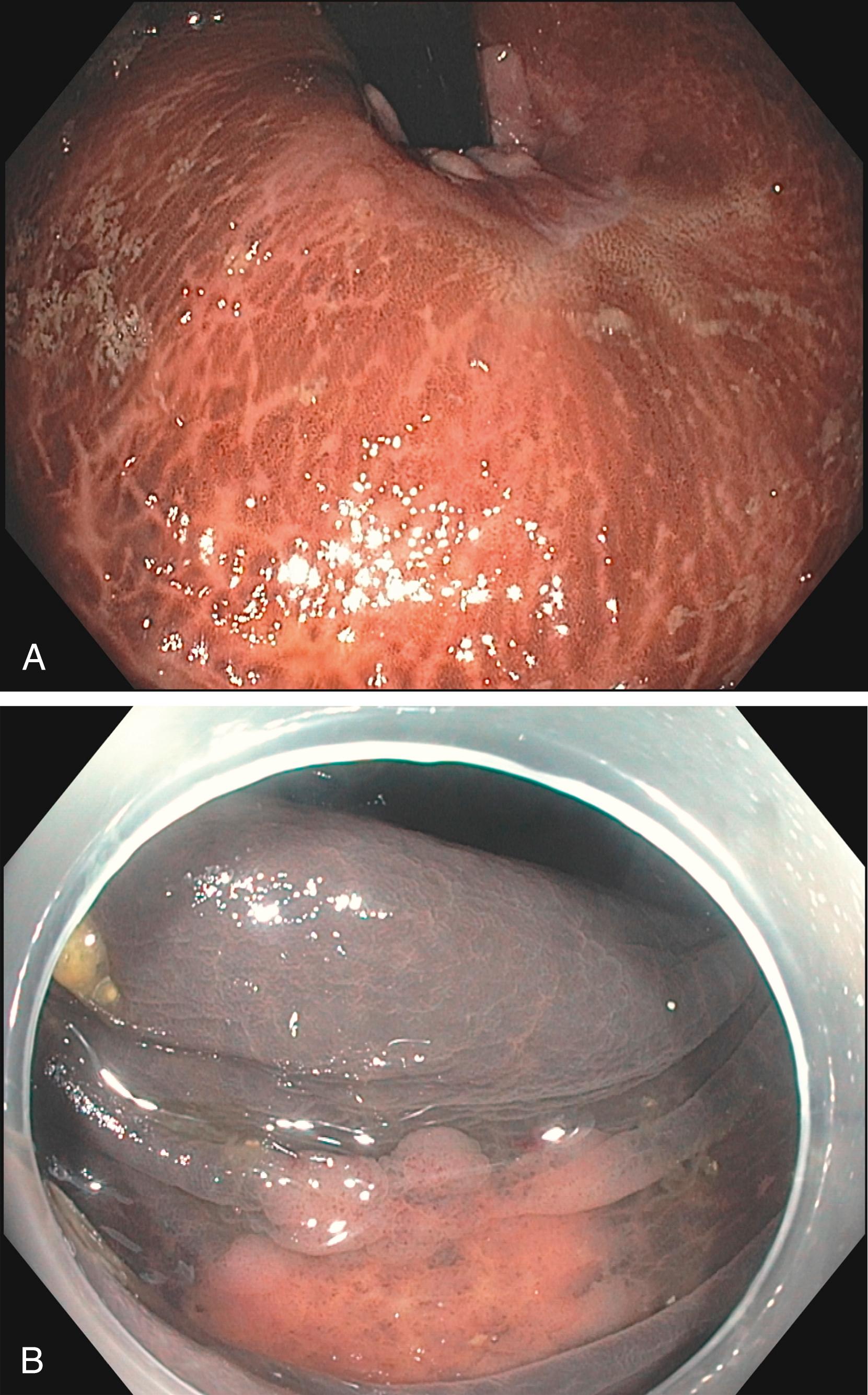 Fig. 128.1, A, A retroflexed colonoscopic view of the brownish discoloration of rectal mucosa consistent with melanosis coli. B, Colonoscopic view of a flat adenoma that is pale and thus easily seen in contrast against the dark background of melanosis coli. The adenoma is pale because it lacks pigment-containing macrophages.