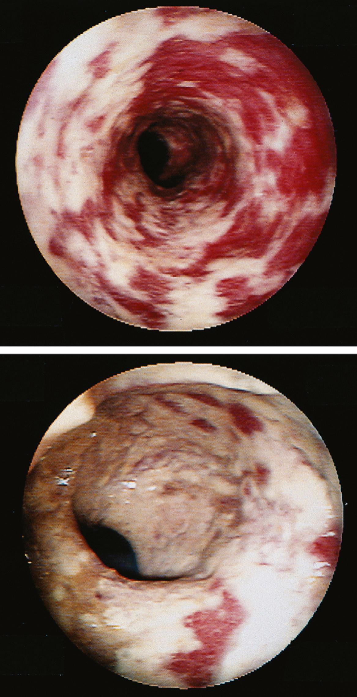 Fig. 128.2, Colonoscopic view of hydrogen peroxide colitis in a patient to whom hydrogen peroxide was given to help remove a fecal impaction. Both panels show the so-called Snow-White sign, referring to the appearance of the stark white necrotic mucosa.