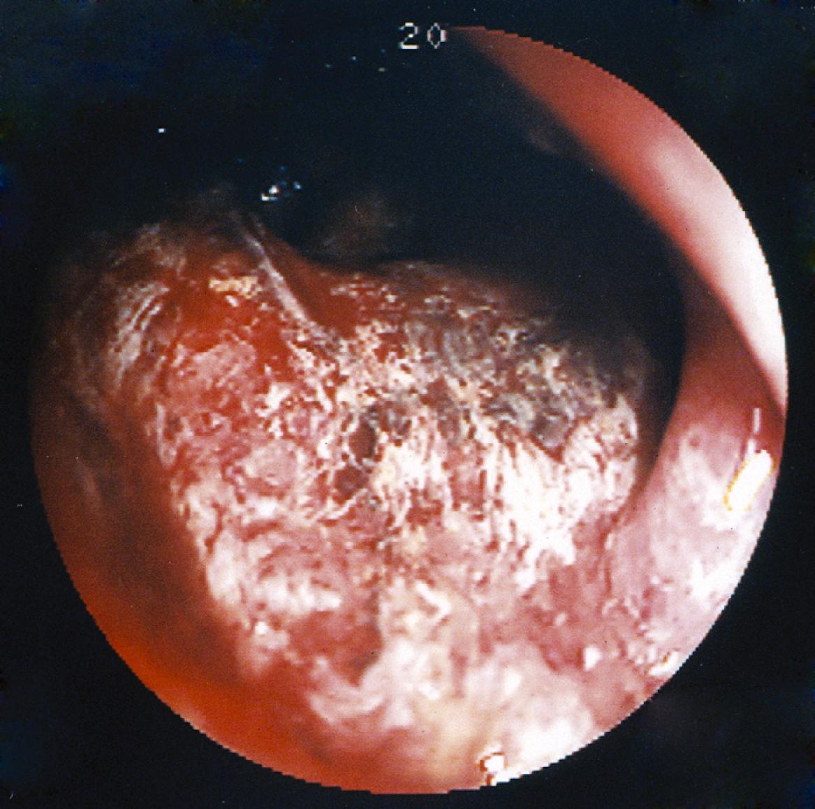 Fig. 128.3, Sigmoidoscopic view of glutaraldehyde colitis in a young man who had had a normal flexible sigmoidoscopy 3 hours before this photograph was taken. The colitis was caused by glutaraldehyde that had been used to disinfect the flexible sigmoidoscope after its previous use but had not been sufficiently cleansed from the instrument. He complained of “agonizing” pain during the sigmoidoscopic examination and began to pass bright red blood 2 hours later.