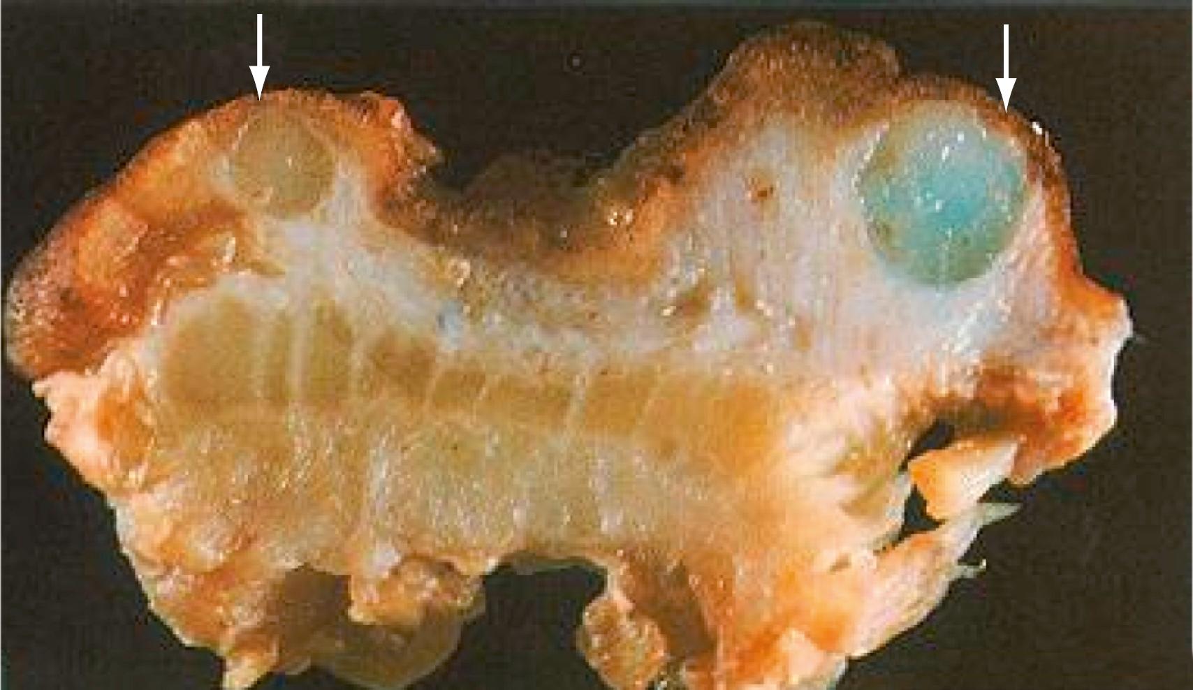 Fig. 128.4, Resection specimen of colitis cystica profunda. Several submucosal cysts are filled with mucinous material (arrows) . This entity occurs in the setting of chronic IBD as well as the solitary rectal ulcer syndrome, among many other disorders. These lesions have been confused with mucinous carcinomas, which also may be seen in chronic IBD.