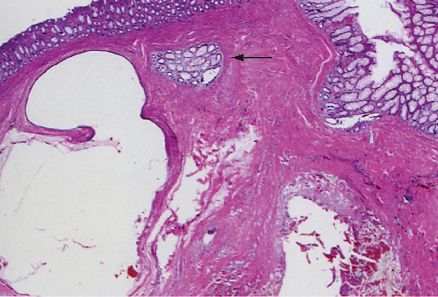 Fig. 128.5, Histopathology of colitis cystica profunda showing the mucus-filled cysts and misplaced epithelium below the muscularis mucosae (arrow) . (H&E, ×5.)