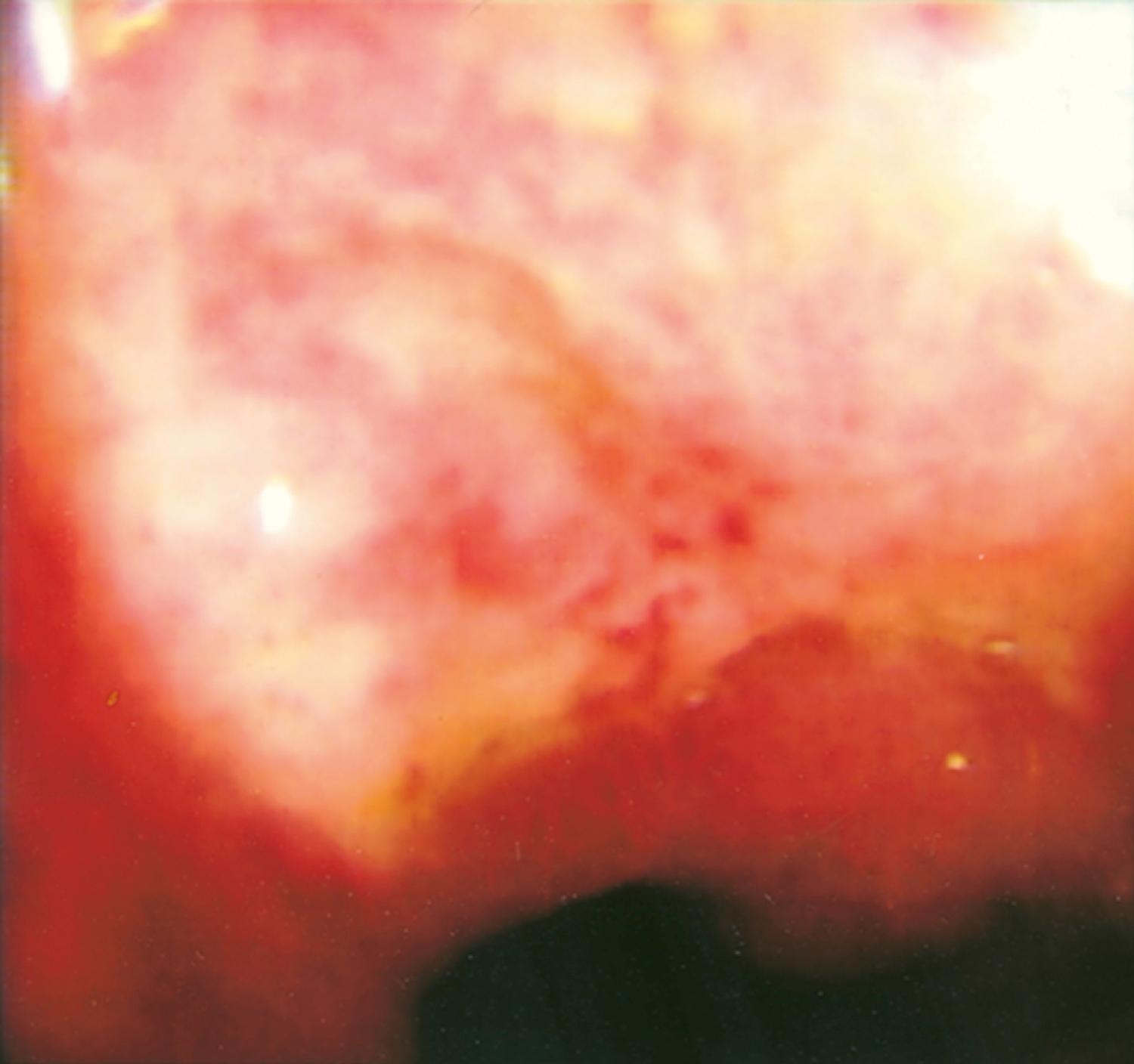 Fig. 128.6, Endoscopic appearance of a non-specific ulcer of the colon.