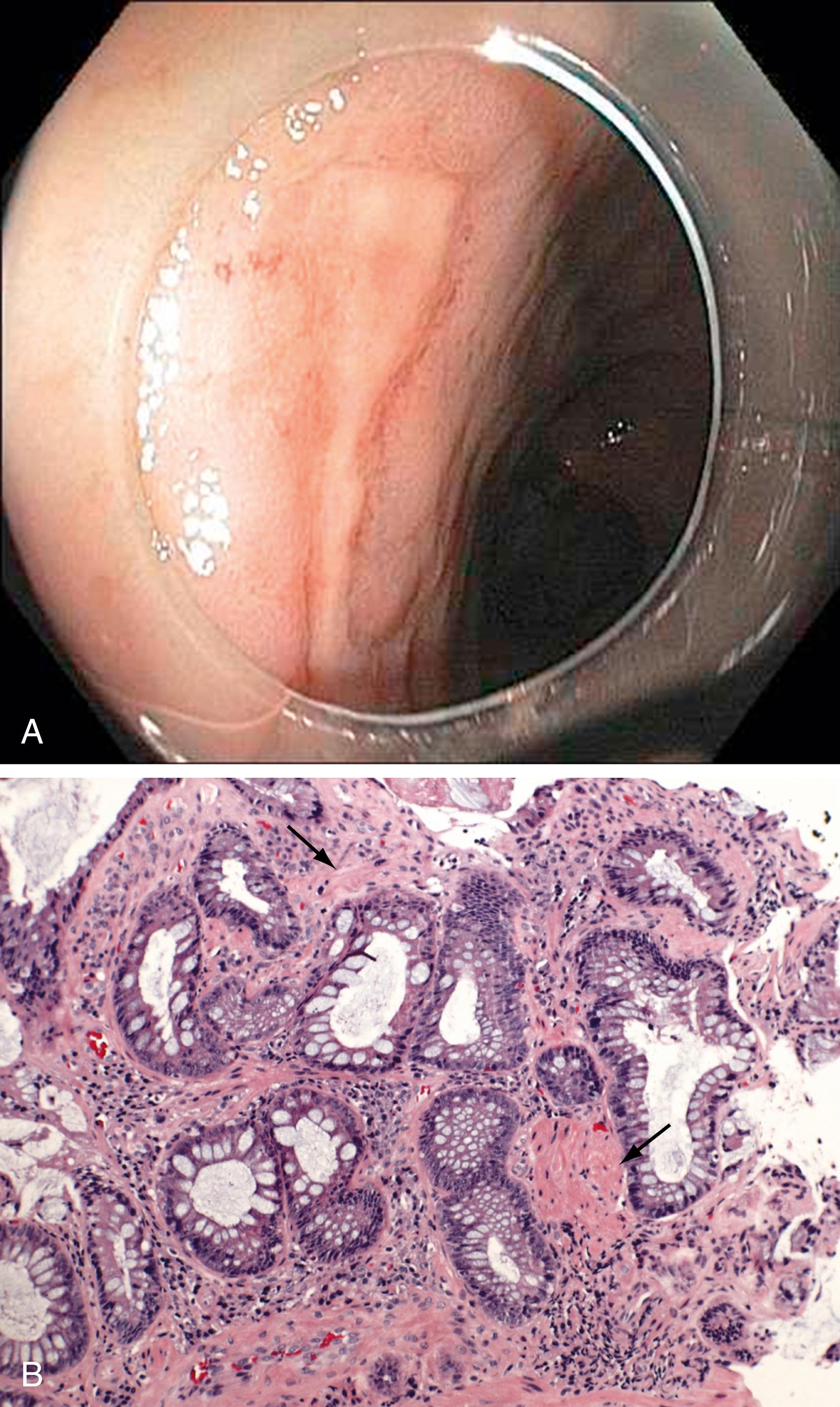 Fig. 128.7, A, Solitary rectal ulcer syndrome (SRUS). Cap-assisted colonoscopic view of a large ulcer seen in the distal rectum 5 cm above the anal verge. ( Courtesy Wong Kee Song, MD, Division of Gastroenterology and Hepatology, Mayo Clinic, Rochester, MN. ) B, Histopathology of SRUS. The findings include disorganized crypts with reactive epithelium, mild lamina propria inflammation, and smooth muscle fibers abnormally present in the mucosa (arrows) . The smooth muscle fibers represent hyperplasia of the muscularis mucosa, a common histologic finding in this condition. (H&E.)