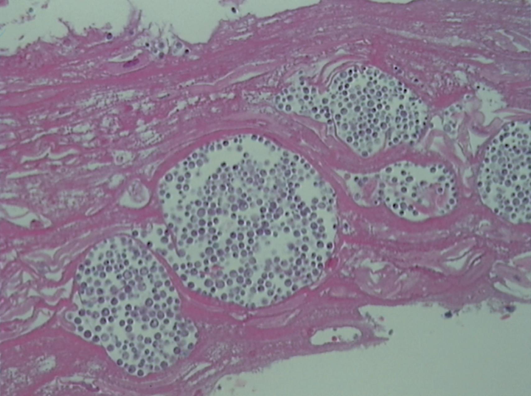 Fig. 23.1, Invasive Candida Esophagitis.