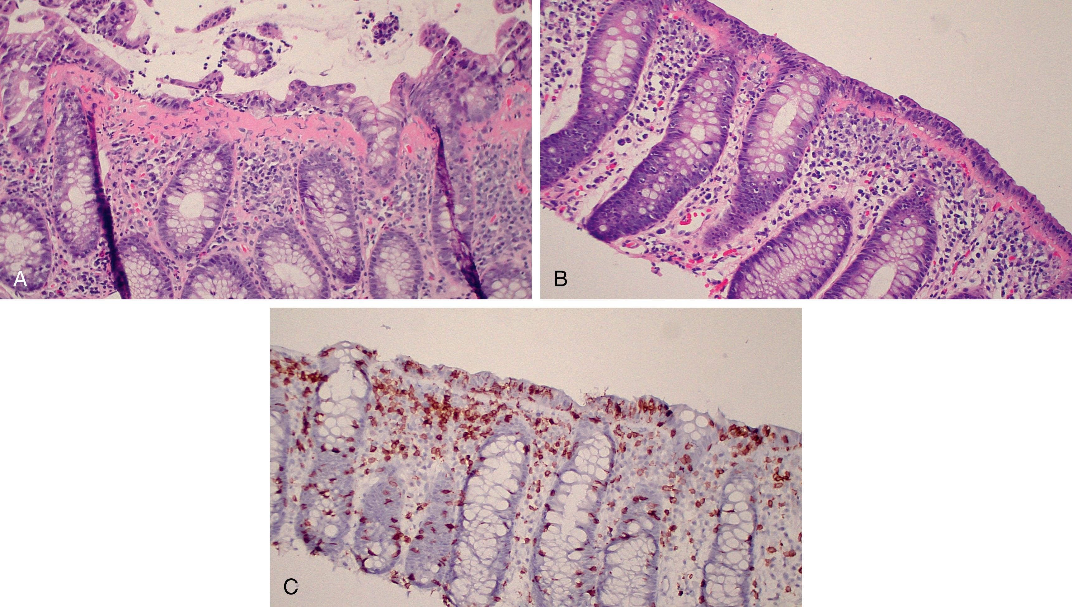 Fig. 49.1, (A) Colonic mucosal biopsy demonstrating thickened (40 microns) subepithelial collagen table and lymphocytes in the superficial epithelium, typical of collagenous colitis. 200×. (B) This lymphocytic colitis case shows increased intraepithelial lymphocytes and damage to the superficial epithelium. It is ragged, flattened, and losing mucous cells. (C) CD3 staining highlights the intraepithelial lymphocytes.