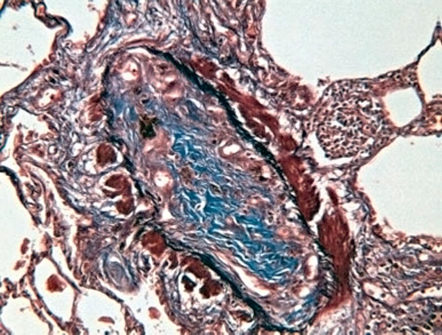 Fig. 422.1, Complete obliteration of airway lumen with fibromyxoid tissue in lung transplant recipient with bronchiolitis obliterans.