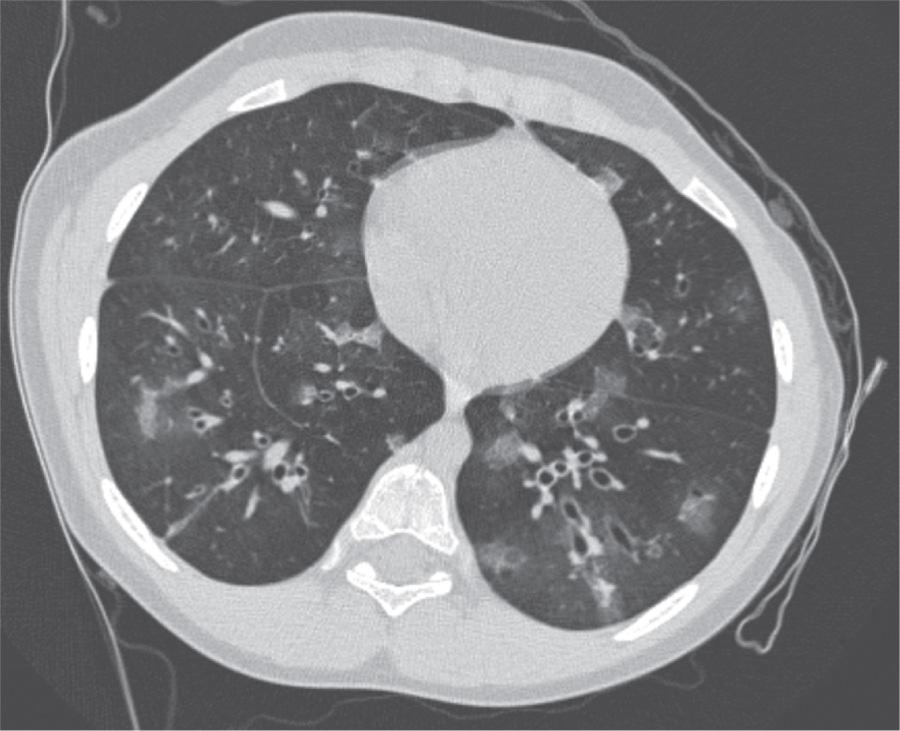 Fig. 422.2, High-resolution CT scan of the chest of a child with bronchiolitis obliterans demonstrating mosaic perfusion and vascular attenuation. Air-trapping is demonstrated by lack of increase in attention or decrease in lung volume in dependent lung.