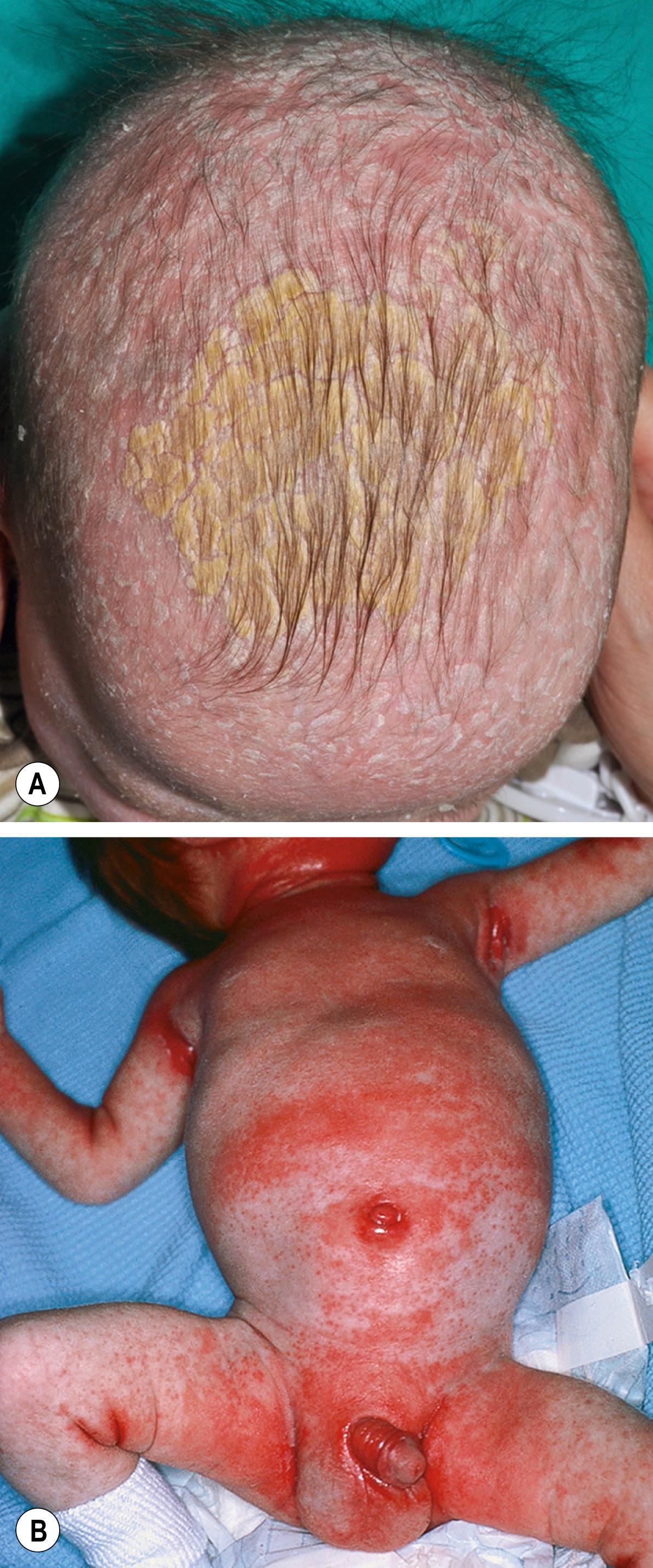 Fig. 11.1, Infantile seborrheic dermatitis.