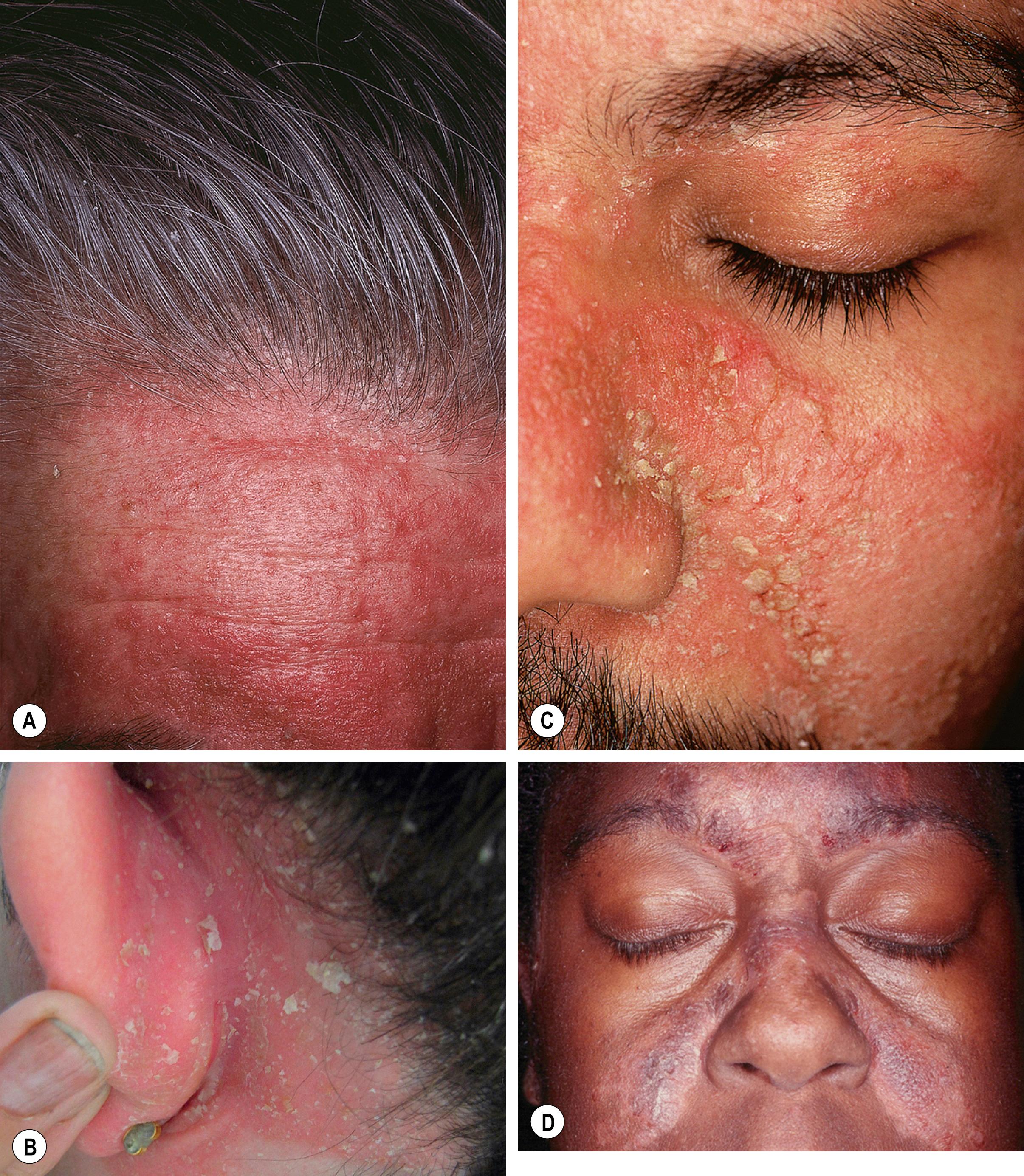 Fig. 11.2, Adult seborrheic dermatitis of the scalp, ear, and face.