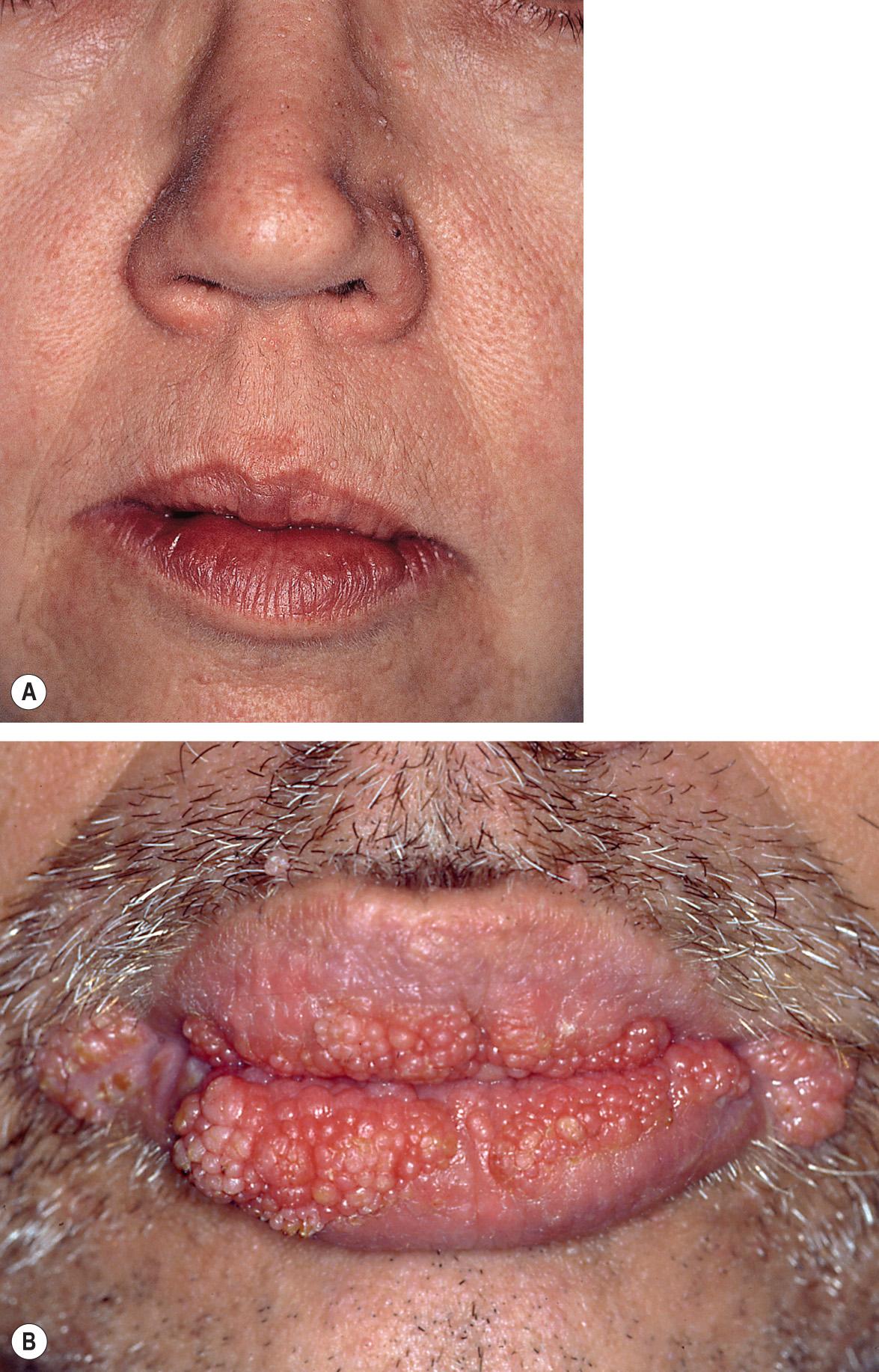 Fig. 63.3, Facial lesions in Cowden syndrome.