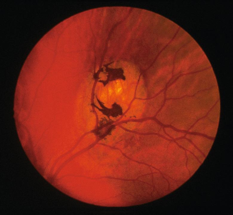 Fig. 63.5, Congenital hypertrophy of the retinal pigment epithelium.