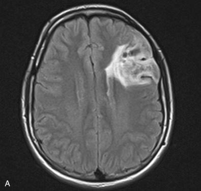 Fig. 9.2, Angiocentric glioma combined with ependymoma showing anaplastic transformation. (A–C) Combined angiocentric glioma and ependymoma. FLAIR-weighted MRI shows a tail-like extension toward the lateral ventricle, a feature seen in a subset of angiocentric gliomas (A). Histology showed regions that were classic for angiocentric glioma in some areas (B), but also included more solid and microcystic areas reminiscent of ependymoma in other areas, which also featured dot-like EMA positivity (C). (D, E) An angiocentric glioma that underwent malignant transformation to an anaplastic ependymoma 2 years after the primary was resected. The recurrence featured a contrast-enhancing component not seen in the original tumor (D). Residual foci of angiocentric glioma (E) were found adjacent to more solid and cellular foci of anaplastic ependymoma (F).