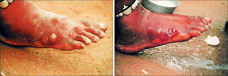 Figure 8-4, Clinical presentation. The female guinea worm induces a painful blister ( A ); after rupture of the blister, the worm emerges as a whitish filament ( B ) in the center of a painful ulcer, which is often secondarily infected.