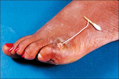 Figure 8-5, An emerged guinea worm is being pulled out from an ulcerated lesion.