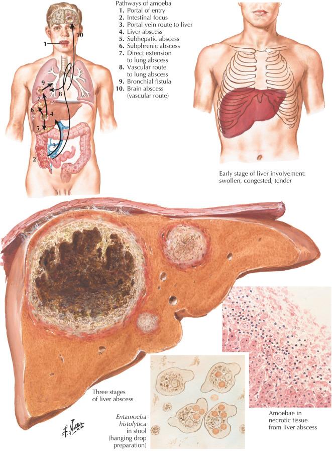 Fig. 179.1, Hepatic Amebiasis: Pathways and Liver Abscess Stages.