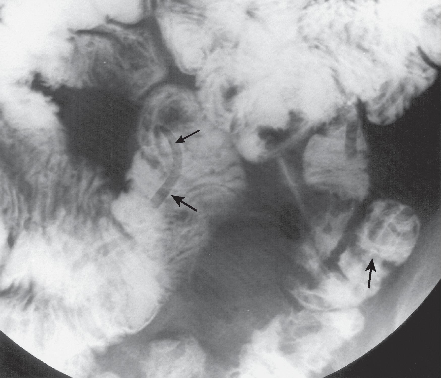 Fig. 28.2, Ascariasis.