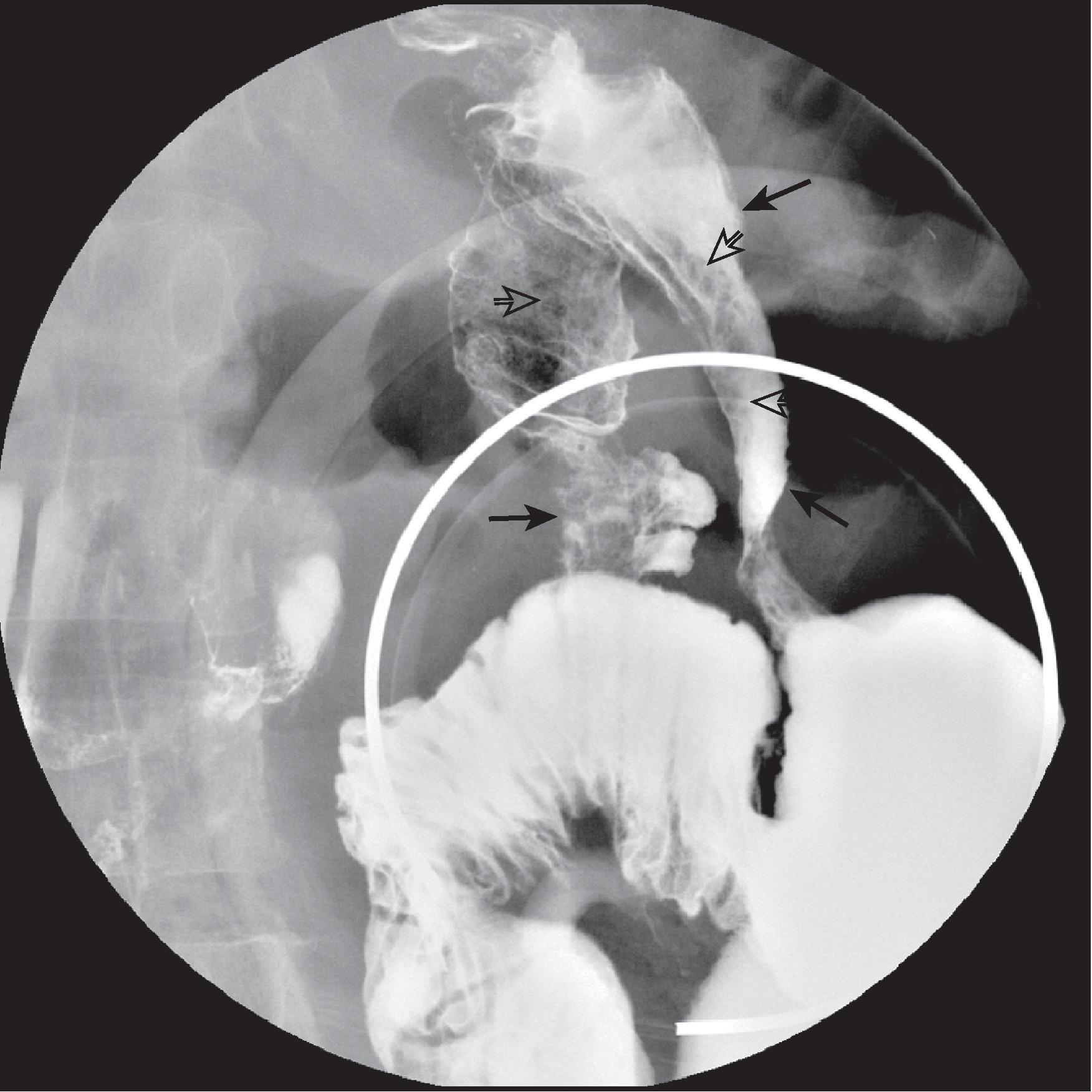 Fig. 28.3, Strongyloidiasis.