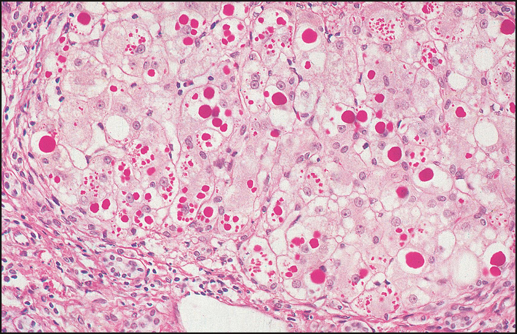 Fig. 77.1, Liver histology in α 1 -antitrypsin deficiency.