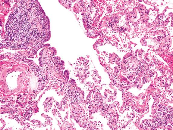 FIG. 17.1, Hypersensitivity pneumonitis. A respiratory bronchiole shows mild lymphoplasmacytic infiltrates in its wall, with a lymphoid aggregate. Similar chronic inflammatory infiltrates extend into adjacent alveolar septa. A cluster of multinucleated giant cells is present, with a cholesterol cleft in the cytoplasm of one giant cell.