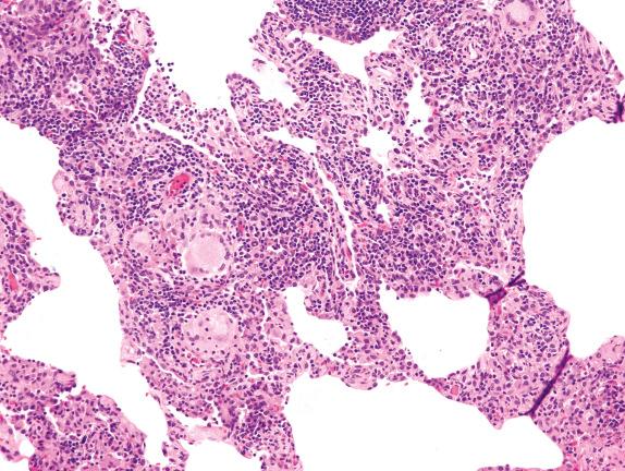 FIG. 17.2, Hypersensitivity pneumonitis. Dense interstitial lymphoplasmacytic infiltrates with scattered multinucleated giant cells are present.