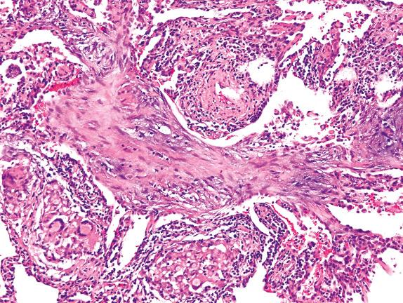 FIG. 17.3, Organizing pneumonia in hypersensitivity pneumonitis. This alveolar duct is largely filled by a plug of connective tissue. Interstitial regions of adjacent alveolar septa are expanded by lymphocytic infiltrates, and occasional multinucleated giant cells are seen.