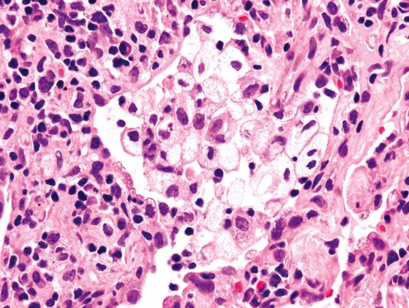 FIG. 17.4, Hypersensitivity pneumonitis. Foamy macrophages occupy an alveolar space, perhaps representing endogenous lipid pneumonia.