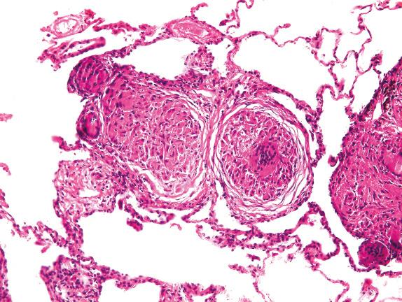 FIG. 17.5, Sarcoidosis. Granulomas are classically compact and nonnecrotizing.