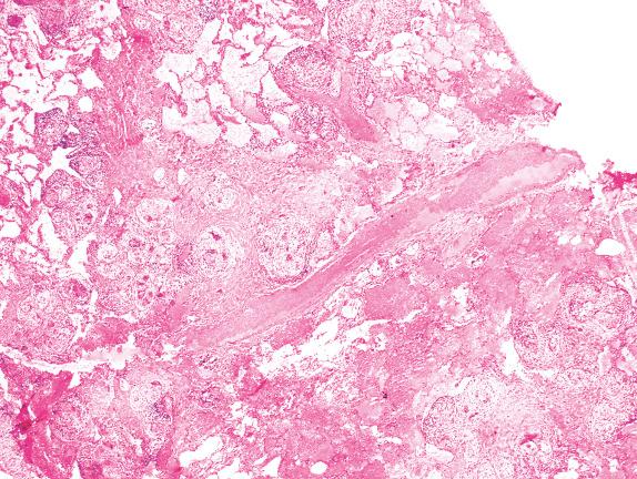 FIG. 17.6, Sarcoidosis. Granulomas are often distributed along lymphatic routes, as is illustrated here.