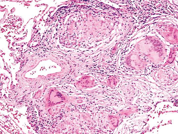 FIG. 17.7, Sarcoidosis. Multinucleated giant cells and a small granuloma lie adjacent to a lymphatic.