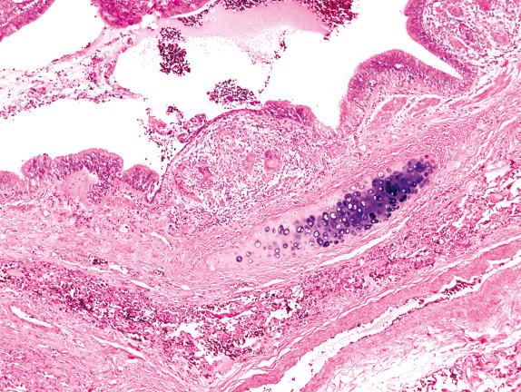 FIG. 17.8, Sarcoidosis. Bronchial granulomas are commonly found in sarcoidosis, as is shown here, accounting for the high utility of bronchoscopy in establishing the diagnosis.