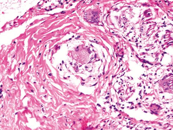 FIG. 17.10, Sarcoidosis. Perigranulomatous hyalinization develops over time in sarcoidosis.