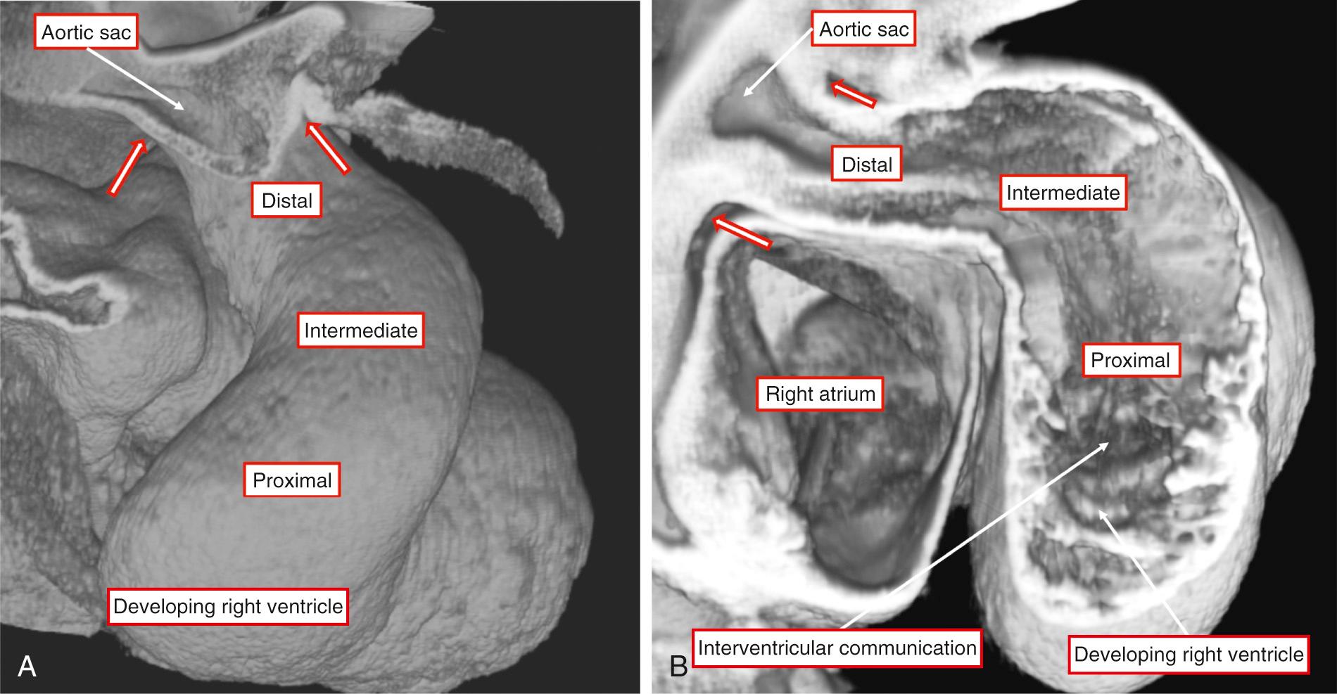 Fig. 51.2, Images taken from episcopic datasets prepared from developing mice sacrificed at embryonic day 10.5. (A) Frontal view of the heart. (B) Oblique section taken across the outflow tract. As can be seen in A, the outflow tract has a dogleg configuration. (B) Cardiac jelly that lines the lumen. The walls of the tube are initially exclusively myocardial all the way to the margins of the pericardial cavity (arrows) . The distal margins are beginning to achieve a nonmyocardial phenotype due to ingrowth of new tissues from the second heart field.