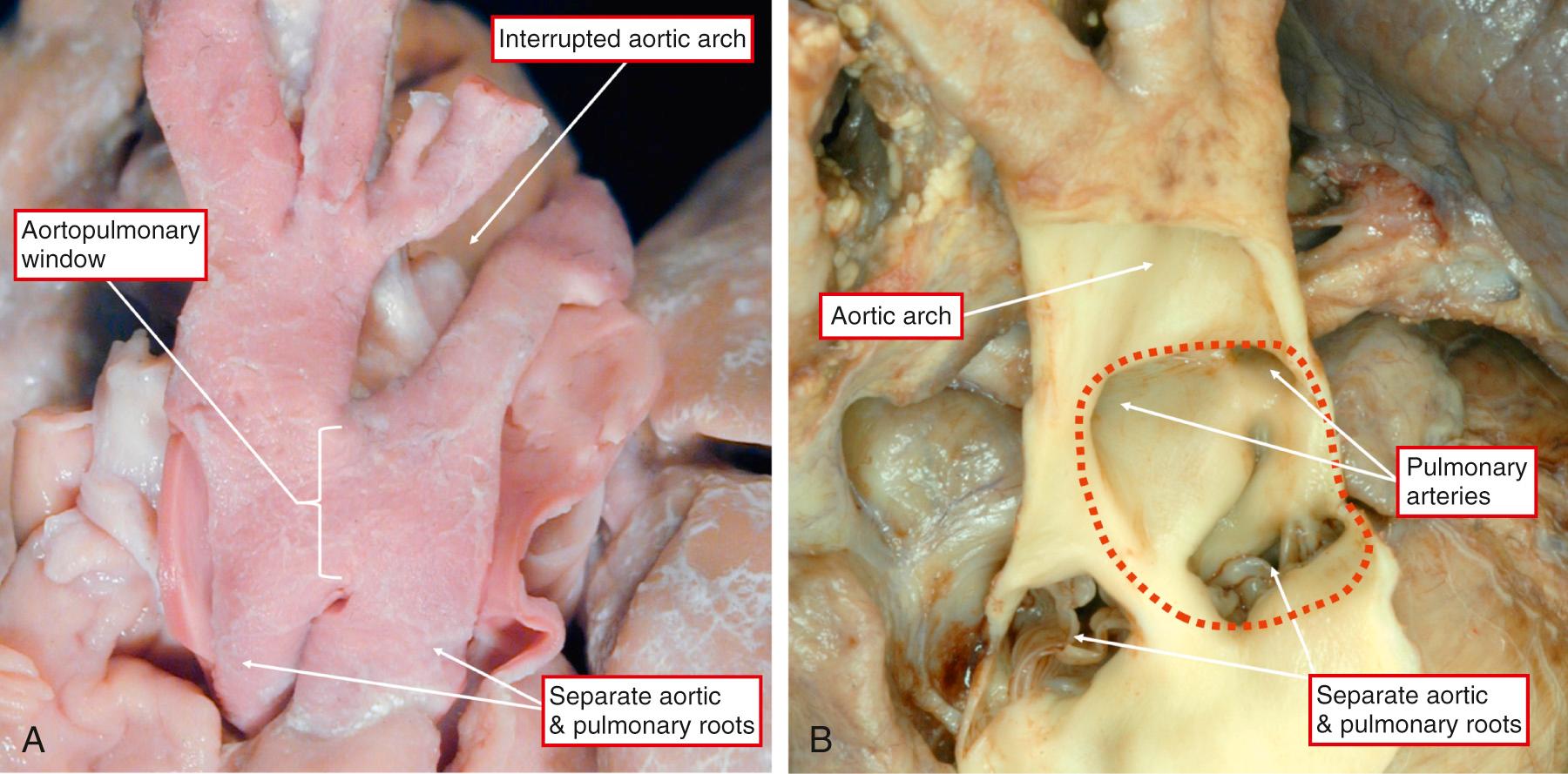 Fig. 51.6, Features of aortopulmonary windows. (A) Example in the setting of interruption of the aortic arch at the isthmus, with the arterial duct supplying the distal circulation from the pulmonary trunk. The arterial trunks are photographed from the front. (B) A large defect (dashed line) viewed subsequent to opening the aorta. Note the presence of the separate aortic and pulmonary roots.