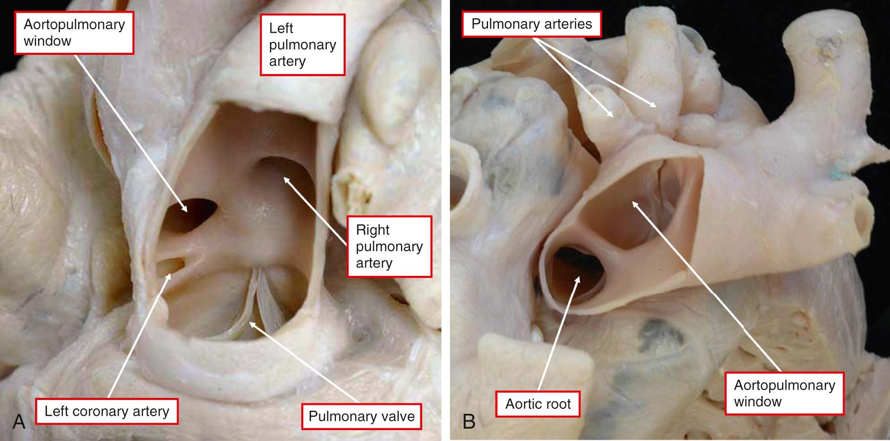 Fig. 51.7, A small aortopulmonary window as seen from the pulmonary trunk (A) and a large aortopulmonary window extending to the margins of the pericardial cavity as seen from the aortic aspect (B). Note the presence of the anomalous origin of the left coronary artery from the pulmonary trunk (A) and the origin of the right pulmonary artery from the aorta (B).