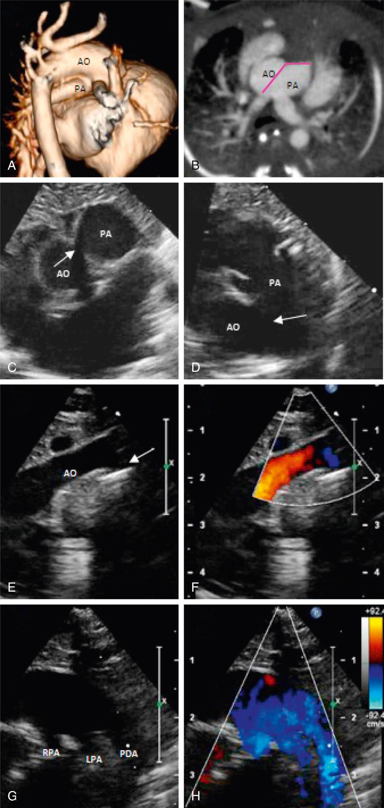 Fig. 51.9, Noninvasive evaluation of aortopulmonary window. Computed tomographic three-dimensional reconstruction of an anteroposterior window (A) and axial view demonstrating aortopulmonary communication (B, pink line ). (C–D) Two-dimensional echocardiogram in short-axis view showing aortopulmonary window ( arrows ). Parasternal long-axis view including two-dimensional imaging (E) and color flow mapping (F) demonstrating type B interrupted aortic arch (arrow) . Short-axis oblique ductal view showing branch pulmonary arteries and large arterial duct in two-dimensional imaging (G) and color flow mapping (H). AO , Aorta; AP, aortopulmonary; LPA, left pulmonary artery; PA, pulmonary artery; PDA, patent ductus arteriosus; RPA, right pulmonary artery.