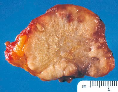 Fig. 33.1, Gross photograph of Ewing sarcoma from chest wall of 10-year-old boy. Foci of necrosis are apparent.