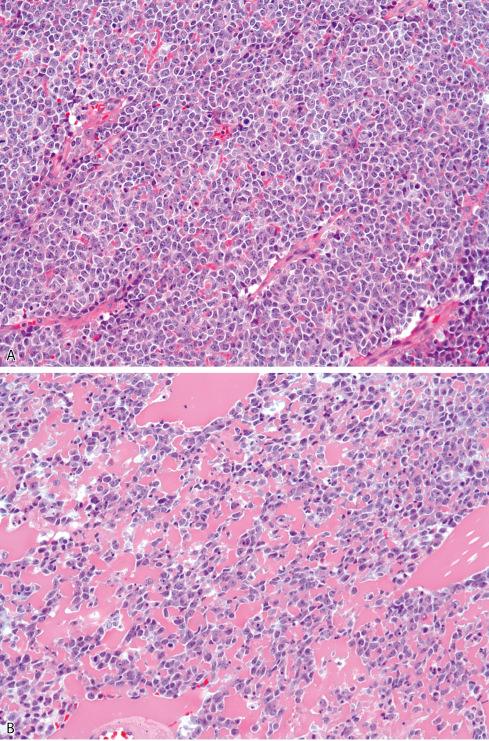 Fig. 33.11, A and B, Ewing sarcoma composed of sheets of larger cells, so called large cell or atypical Ewing sarcoma.