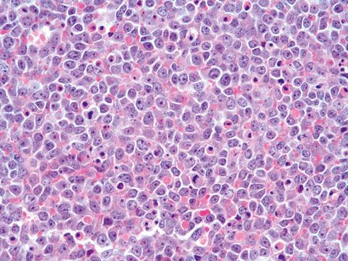 Fig. 33.12, High-power view of large cell Ewing sarcoma.