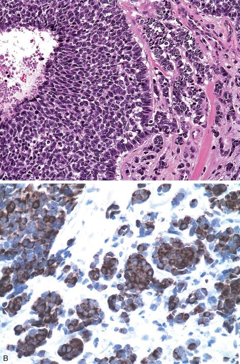 Fig. 33.13, A, Adamantinoma-like Ewing sarcoma with keratin immunoreactivity ( B ).