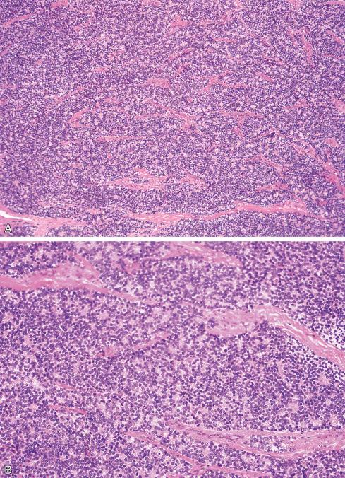 Fig. 33.14, A and B, Ewing sarcoma with distinctive lobular architecture and numerous Homer Wright rosettes apparent at low magnification.