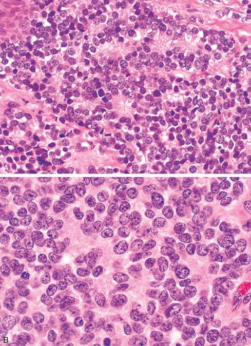 Fig. 33.15, A and B, Ewing sarcoma with Homer Wright rosettes.