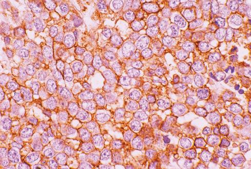 Fig. 33.16, Strong membranous CD99 immunoreactivity in Ewing sarcoma.