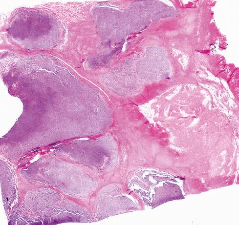 Fig. 33.18, Low-magnification view of a CIC-DUX4 –translocated sarcoma arising in a thigh of 33-year-old woman. Note lobular growth pattern with fibrous septa.